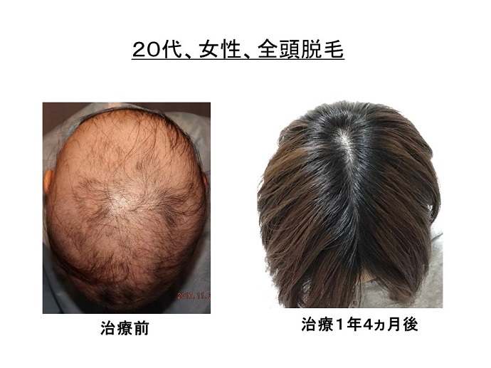 円形脱毛症　病院